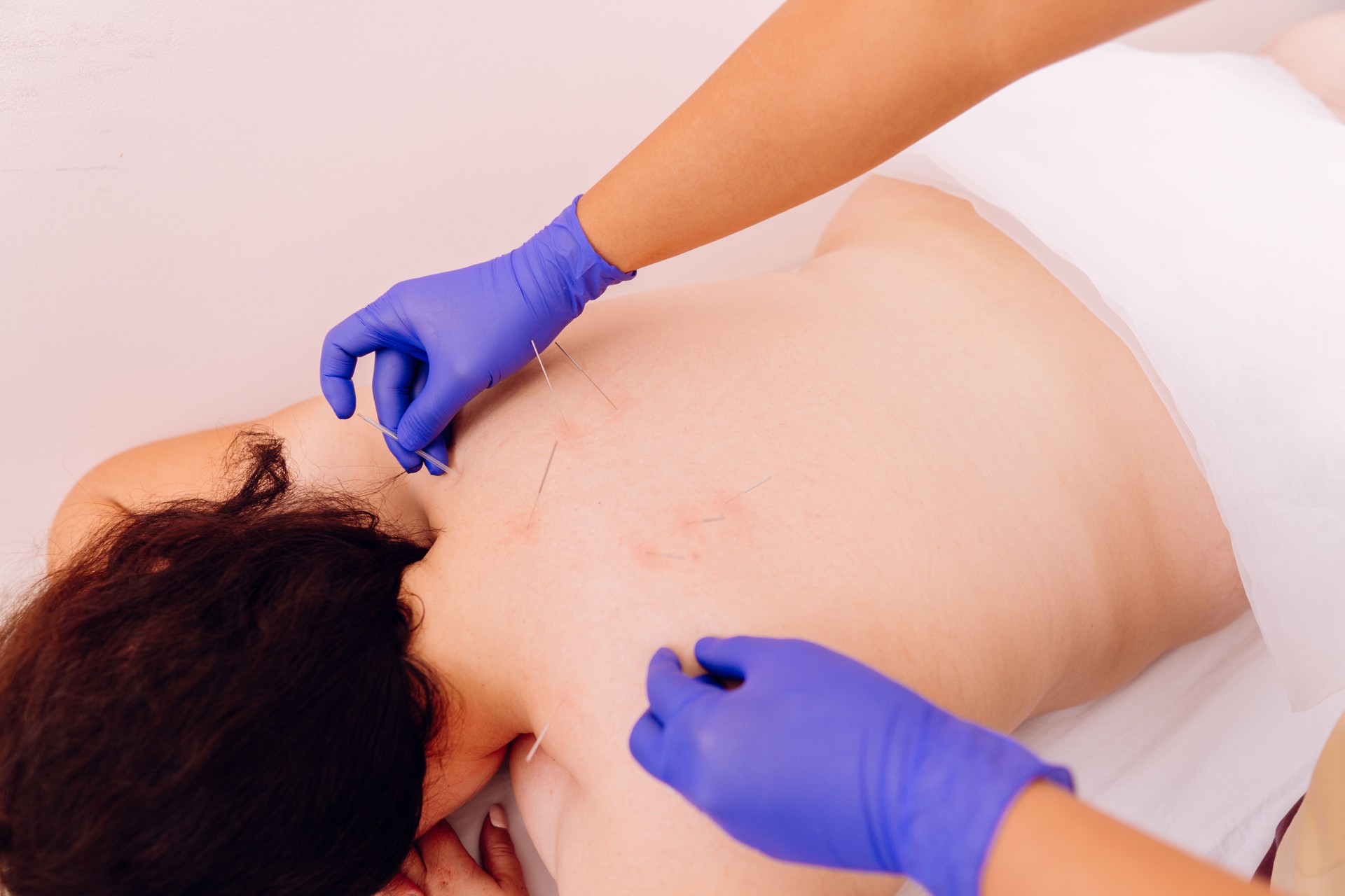 Physiothérapeute faisant l'acupuncture sur le dos de la femme